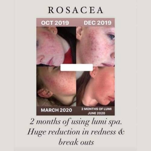 *AUTHENTIC* ageLOC LumiSpa Beauty Device Face Cleansing Kit + Activating Cleanser of Your Choice