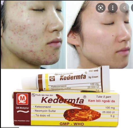 BEST SCAR AND ACNE TREATMENT -  Snake Balm Ointment 5g/Tube Nourishing