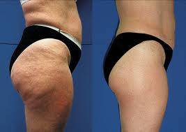 1 Cellulite treatment