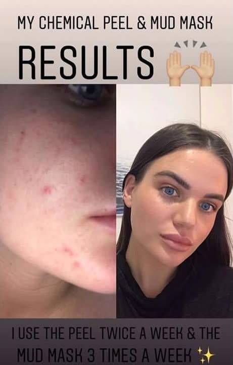 Nu Skin AHA Facial Peel and Neutraliser