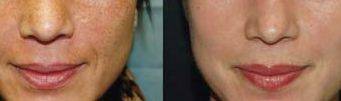 50ml 20% Glycolic And Lactic Acid Chemical Peel Acne Treatment