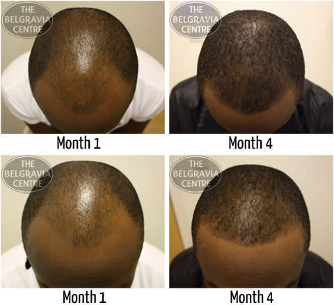 Brilliant and Potent Quick Grow and Anti - Hair Loss Horse Hair Shampoo Treatment
