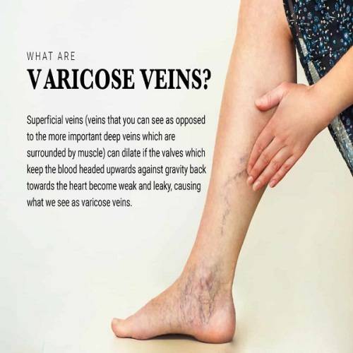 Instant Relief & Highly Effective Varicose Veins Patch