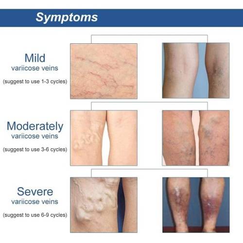 Instant Relief & Highly Effective Varicose Veins Patch