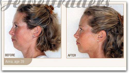 JT - Neckline Slimmer Firms, Tightens & Tones muscles of the neck