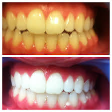 Bright White ~Teeth Whitening Pen Tooth Gel Whitener Bleaching System ~ Instand Staitn Removal