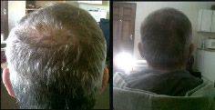 HAIR EVOLUTION Peanie Hair Tonic