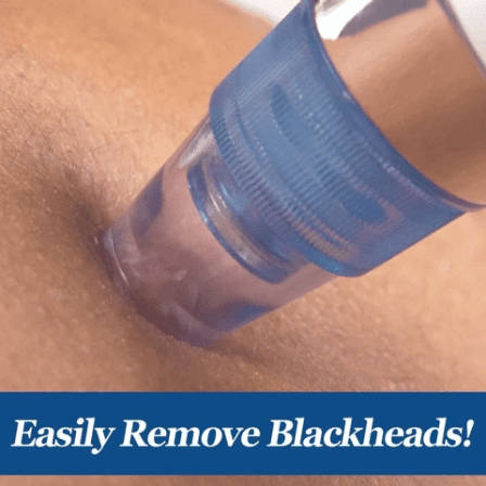 Dermasuction Blackhead Remover