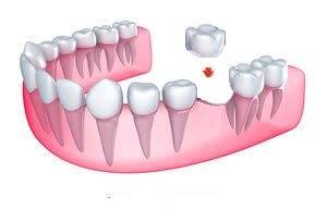 DIY Replacement tooth 5g
