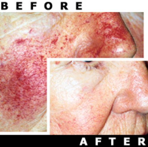 PHOTENZA Laser Wand, ANTI-AGING, Hair Loss, Acne, Pain, Burns, Scars, Wrinkles, etc.