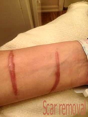 Skin silicone scar sheets