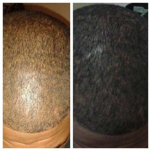 Restore Hairline, Grow Hair - NuLengths African Hair Growth Treatment - Stop Hair Loss Now!