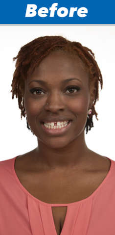Artificial Teeth