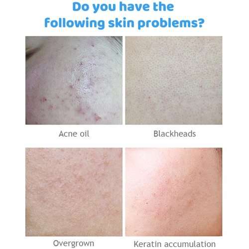Aichun Beauty 2% Salicylic Acid Serum for Acne Prone Skin