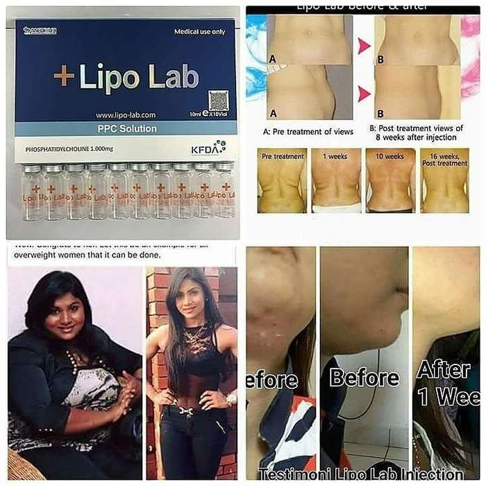 1000mg Insane Winter Special PPC LipoLab Slim1vial=20injection Weight loss.skin thigtening-lifting
