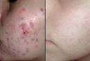 Laser Therapy : Cellulite- Wrinkles - Hair Growth - Acne (Regeneration of New Cells)