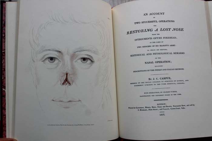 Restoring a lost nose- Carpue