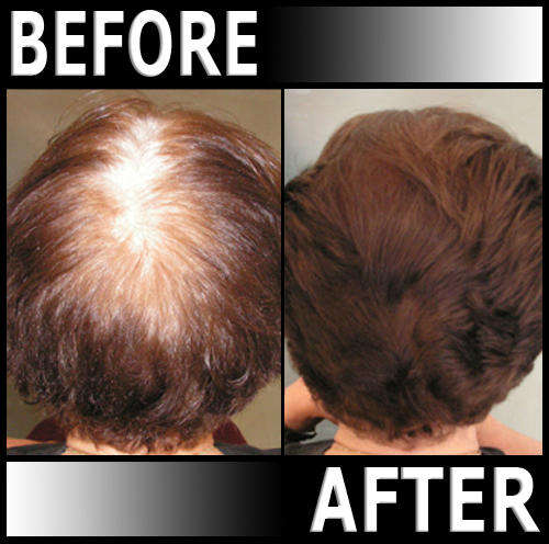 PHOTENZA Laser Therapy Machine for Hair Loss, Acne, Pain, Burns, Scars, Wrinkles, LLLT, etc.