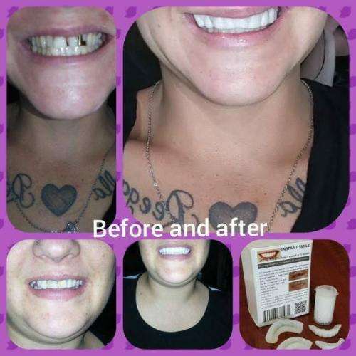Instant smile kits