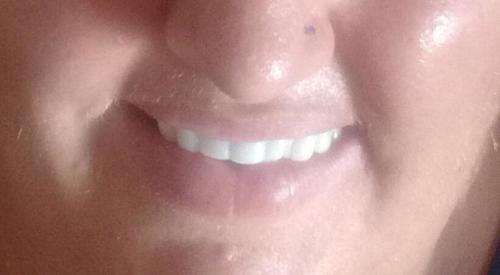 Instant smile kits