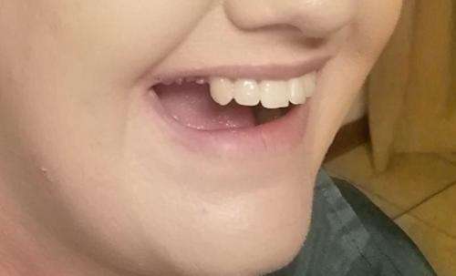 Instant smile kits