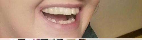 Instant smile kits