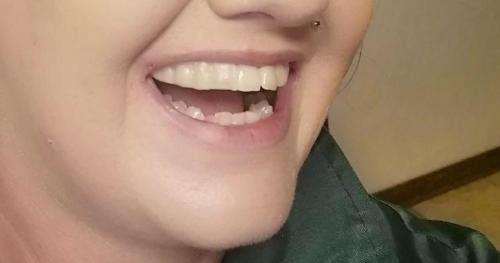 Instant smile kits