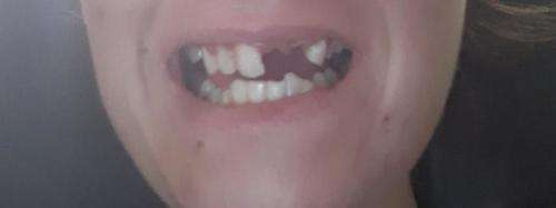 Instant smile kits