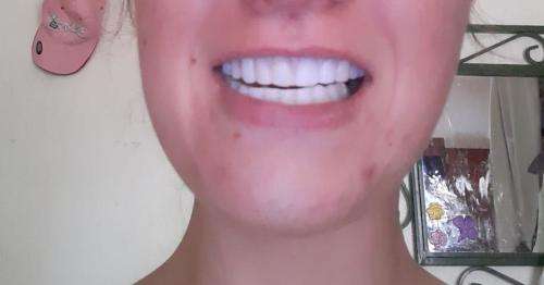 Instant smile kits