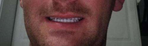 Instant smile kits