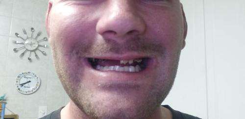 Instant smile kits