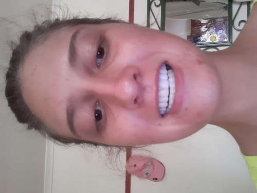 Instant Smile Kits