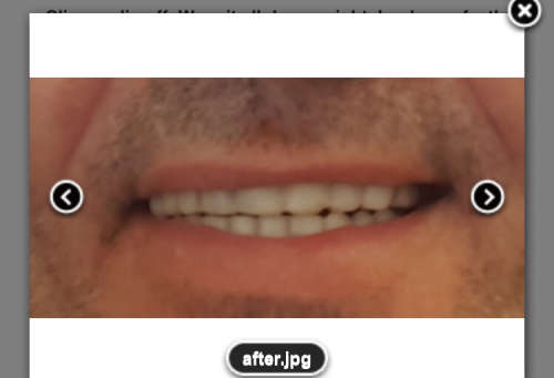Instant Smile Kits