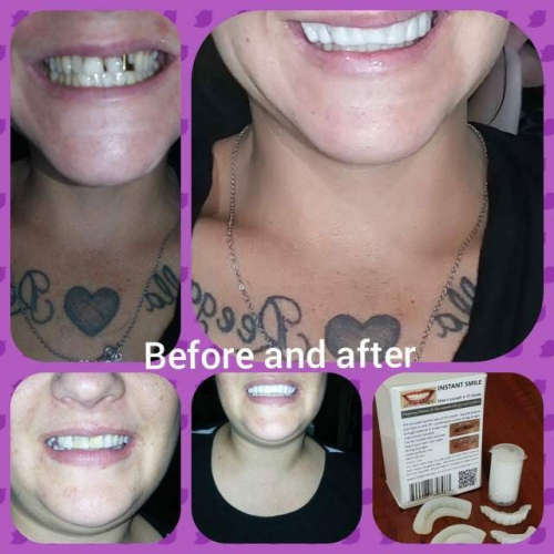 Instant Smile Kits