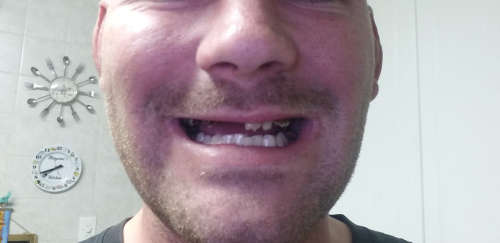Instant Smile Kits