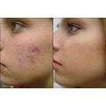 STOP: Acne - Pain - Hair Loss - Celluite - Wrinkles & more...! * * DONT MISS OUT * *