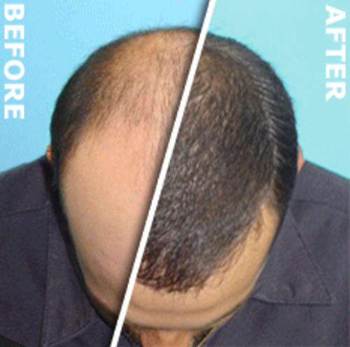 Laser Therapy Wand: Acne - Hair Loss - Celluite - Wrinkles - Look younger in minutes! LLLT R1