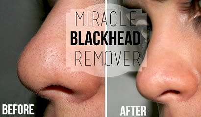 Skin, blackhead remover, peel off face mask, Shills
