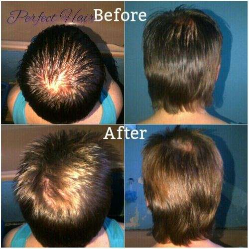 NuLengths Platinum Hair Growth Treatment