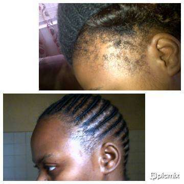 Restore Hairline, Grow Hair - NuLengths African Hair Growth Treatment - Stop Hair Loss Now!
