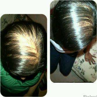 Peanie Natural Hair Tonic, Hair Growth, Hair Products, Hair Evolution, 3cm in 3 days, alopecia, scalp