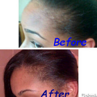 Peanie Natural Hair Tonic, Hair Growth, Hair Products, Hair Evolution, 3cm in 3 days, alopecia, scalp
