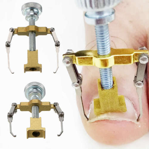 Ingrown Toe Nail Recover Toenail Correction  Fixer Straightener Pain relief