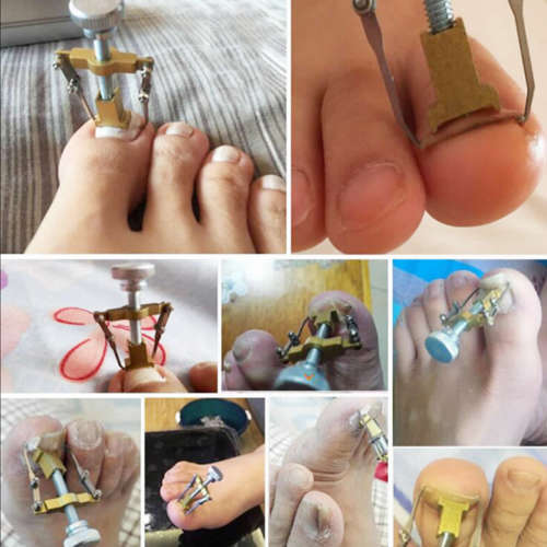 Ingrown Toe Nail Recover Toenail Correction  Fixer Straightener Pain relief