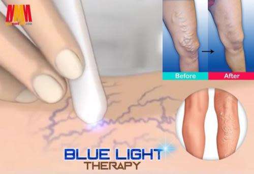 Blue Light Therapy Laser Pen Varicose Vein/ Scar / Acne/ Wrinkle Removal Treatment