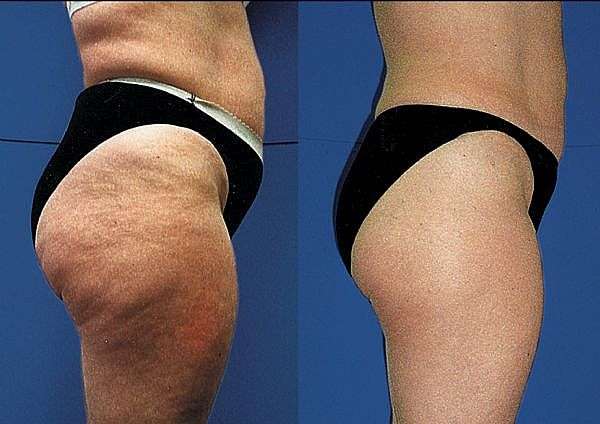 Imported Satin E for strechmarks and cellulite New Stock