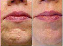 FREE FACE SERUM!  .05 Derma Roller - Smooth out wrinkles and scars PRICE NEVER TO BE REPEATED