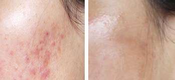 FACE SERUM FREE!  - .75 Derma Roller. Smooth out wrinkles and scars. PRICE NEVER TO BE REPEATED