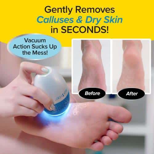 Foot Callus Remover with Built-in Vacuum Function Remove Dead Skin from Feet - Electric Callus Remov