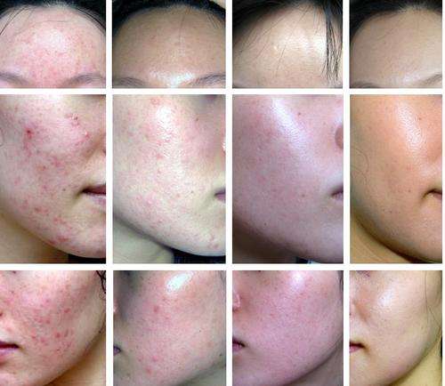 Age reversal, anti-aging, modern medicine, laser therapy, soft laser, cold laser, laser lipo, laserlipo, laser lipolysis, low level laser therapy